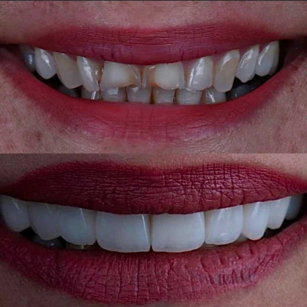 antes-y-despues-smile-design-3_optimized