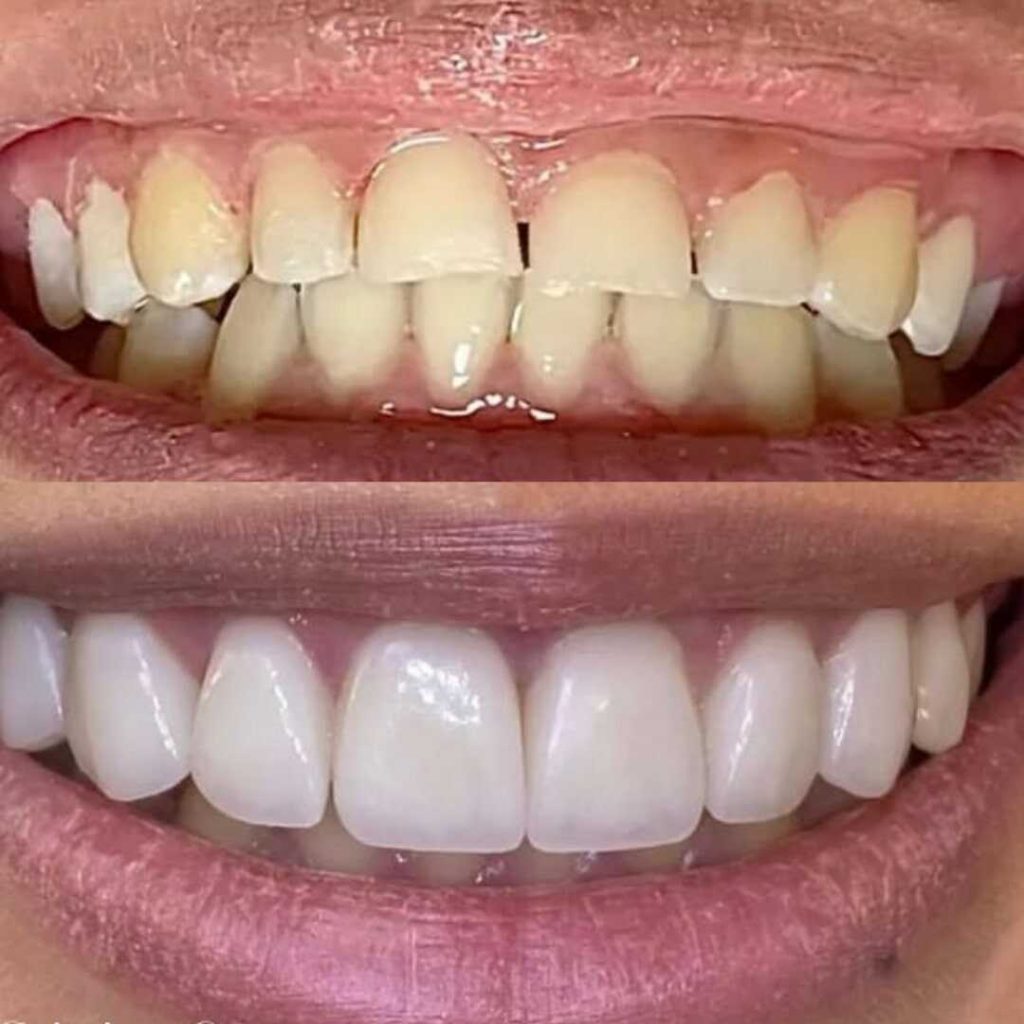 antes-y-despues-smile-design-1_optimized-1024x1024