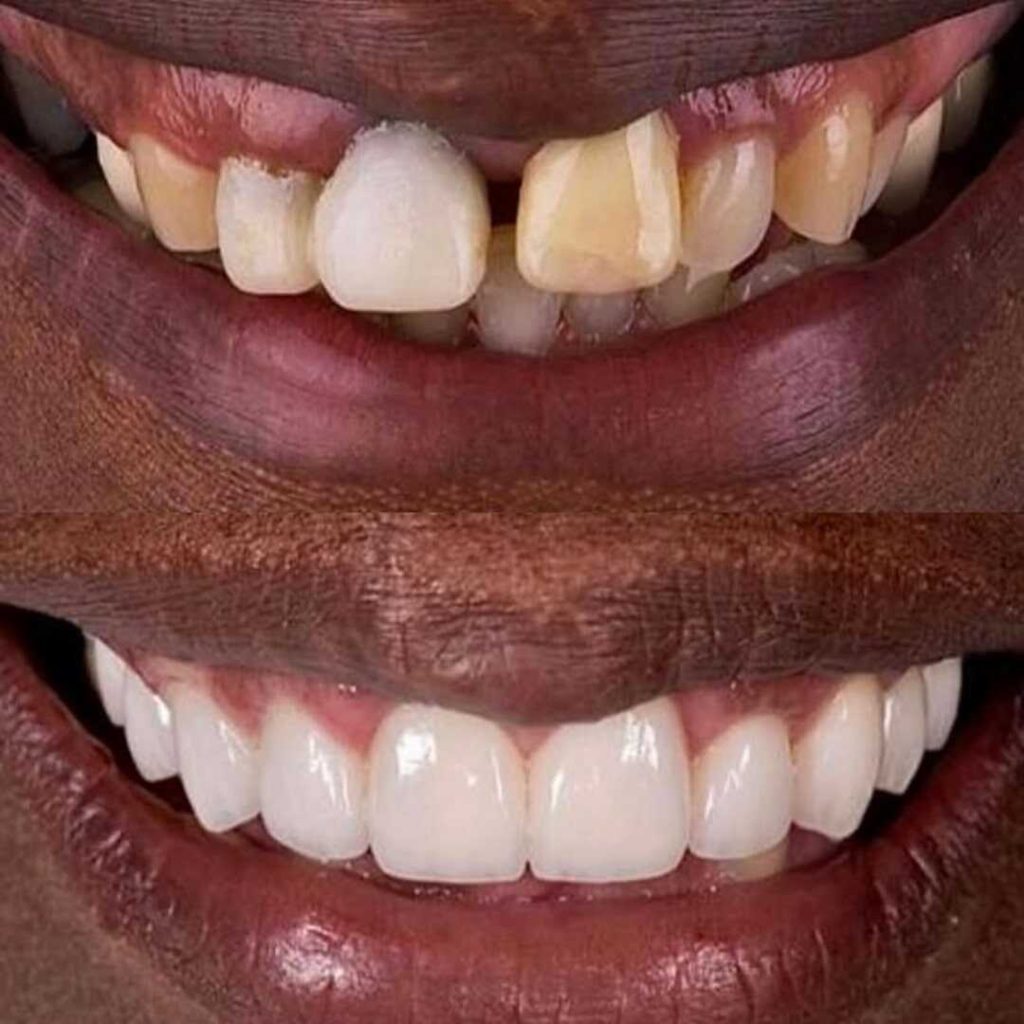 antes-y-despues-smile-design-2_optimized-1024x1024