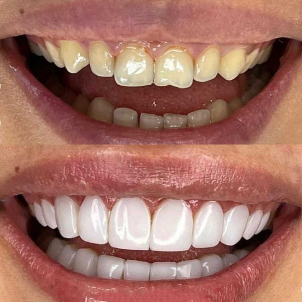 antes-y-despues-smile-design-4_optimized-1024x1024