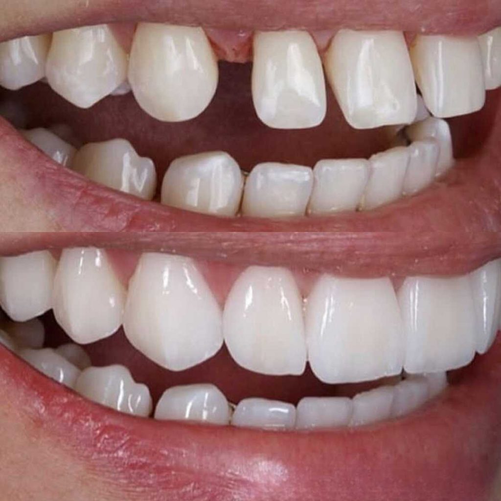 antes-y-despues-smile-design-5_optimized-1024x1024