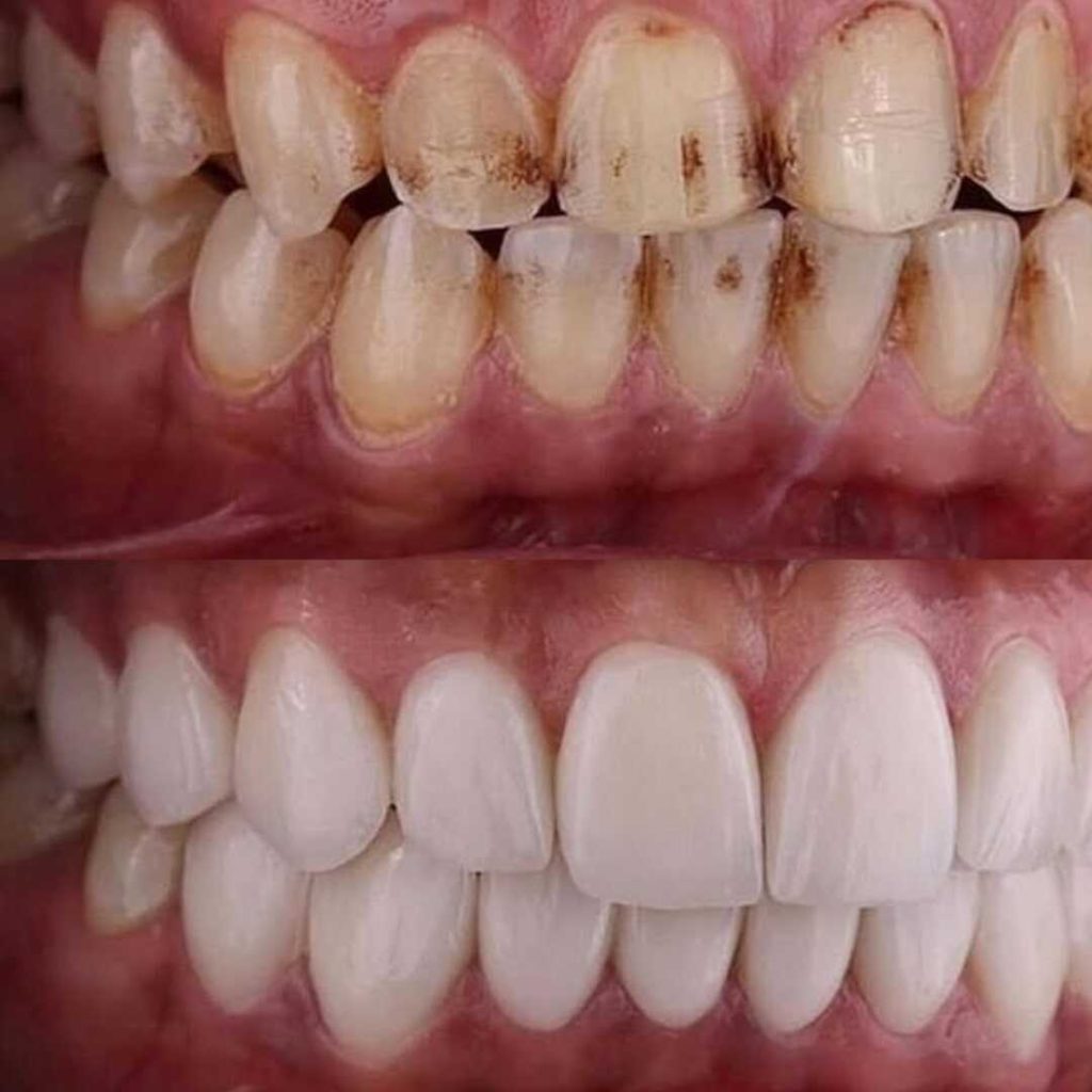 antes-y-despues-smile-design-7_optimized-1024x1024